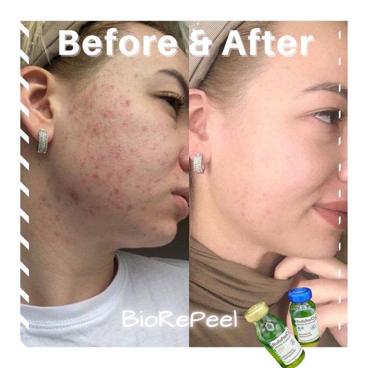 Voor en na resultaat BioRePeel bij acnebehandeling bij YOURSKIN in Apeldoorn