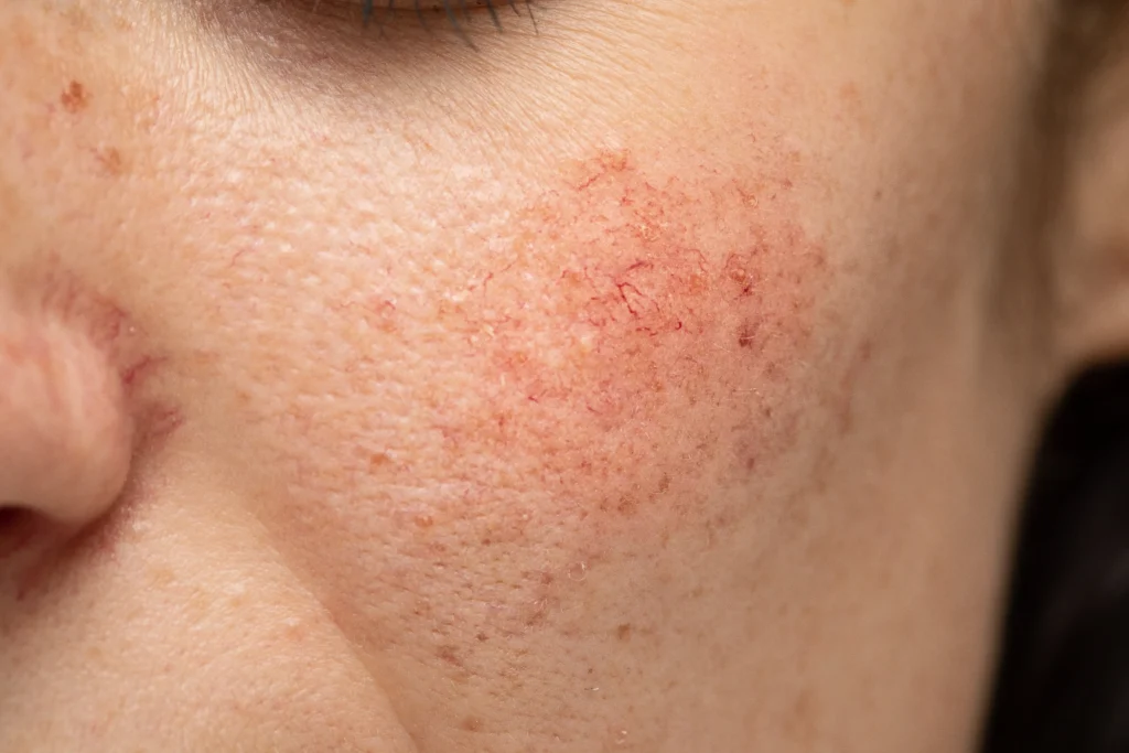 Rosacea verwijderen bij Yourskin in Apeldoorn