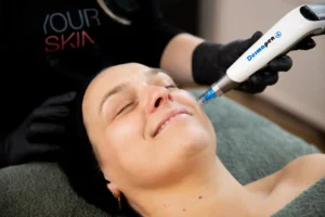 Waarom een Microneedling behandeling YOURSKIN in Apeldoorn