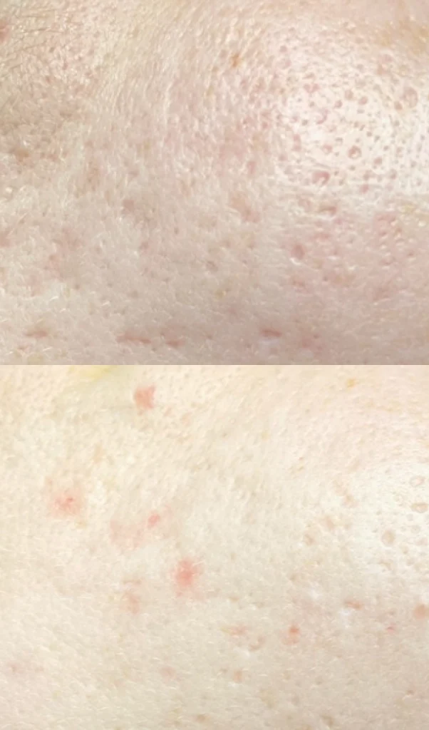 Voor en na resultaat microneedling