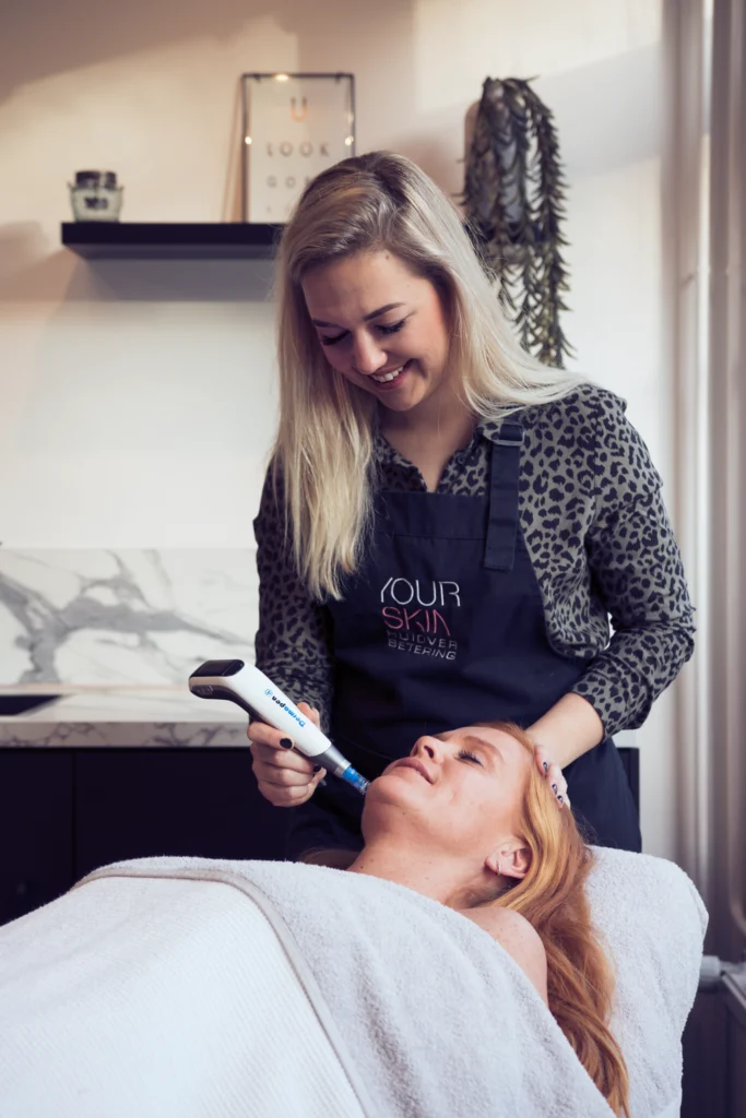 Microneedling door Corine bij YOURSKIN