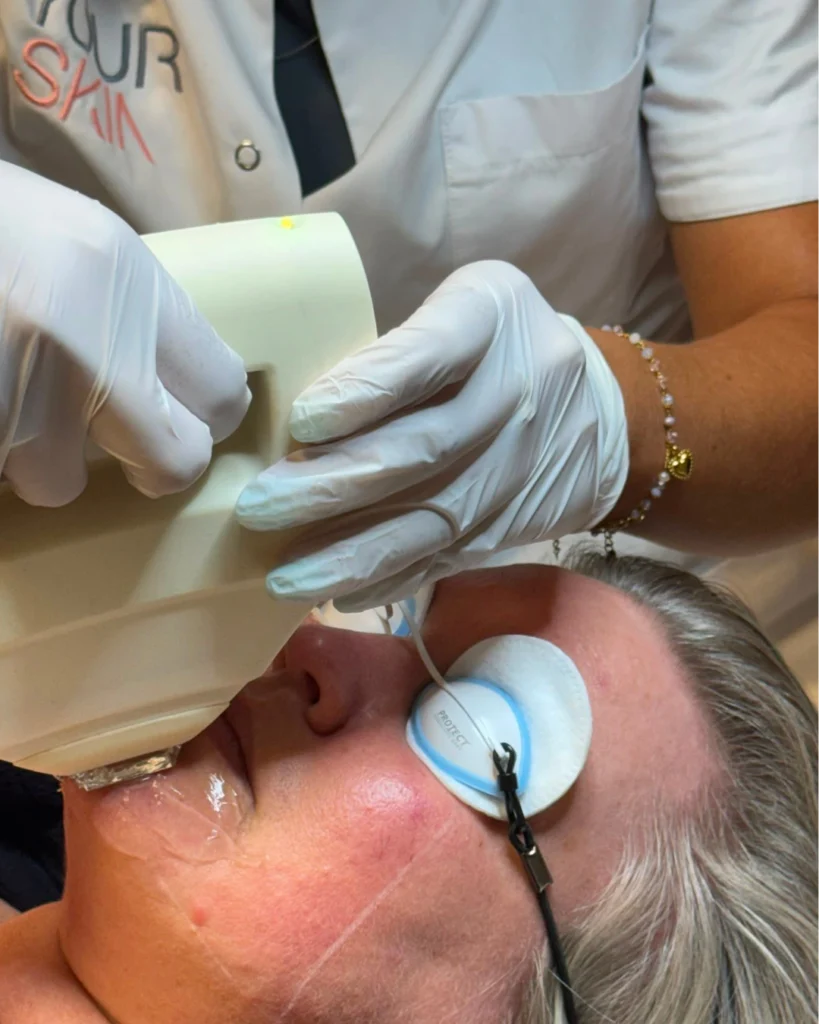 IPL-behandeling-1