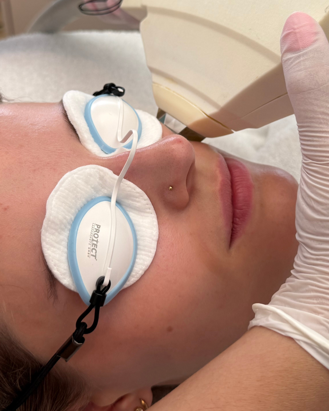 IPL-behandeling-3