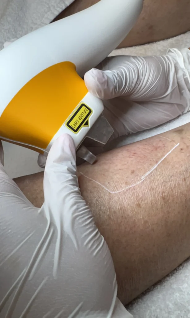Vaatlaser-behandeling-1