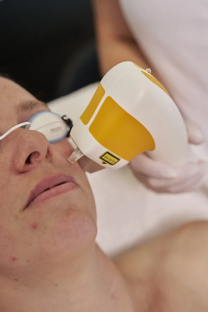 Vaatlaser-behandeling-2